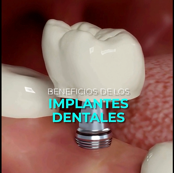 Hablamos de los beneficios de los implantes dentales en Illapel
